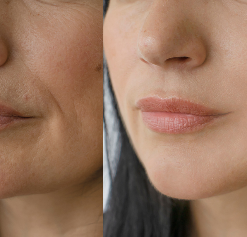 Who is the Best Candidate for Laser Skin Tightening?