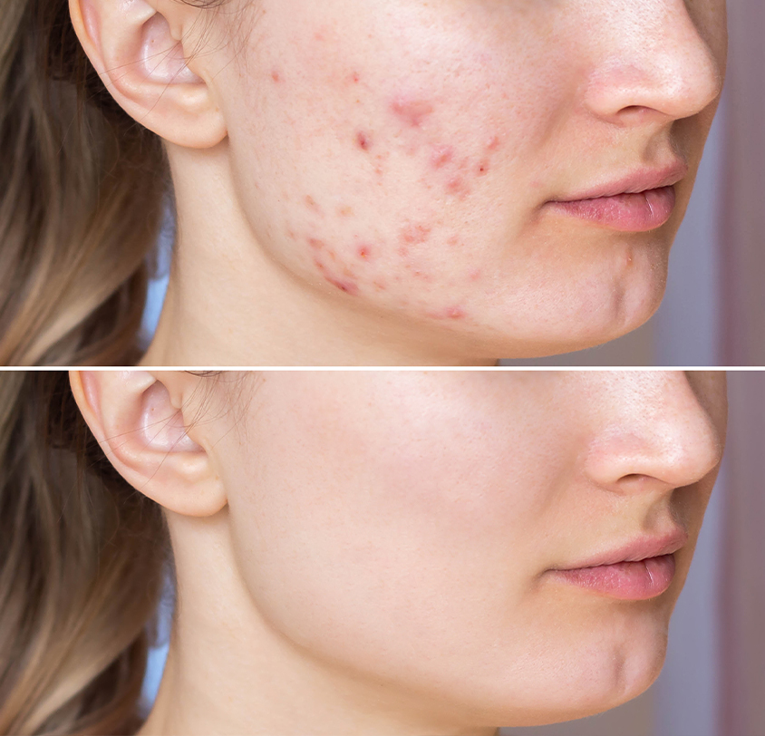 How Does Radiofrequency Treatments for Acne Work?