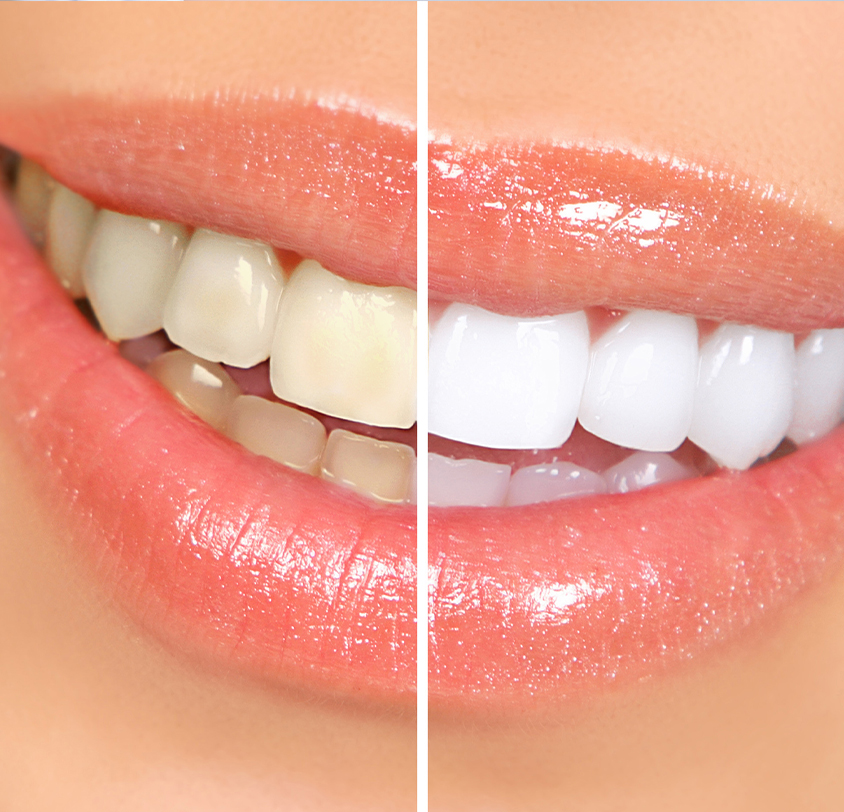 What is teeth whitening?