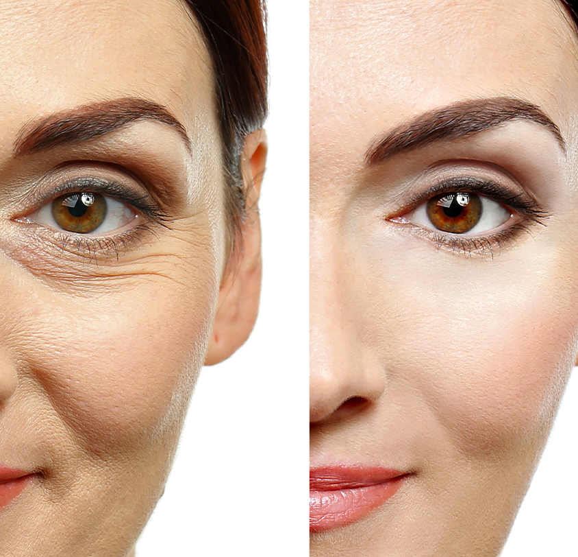 How is Sculptra different from other dermal fillers?