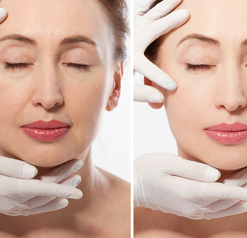  What Can You Expect During Your Dermal Filler Treatment?