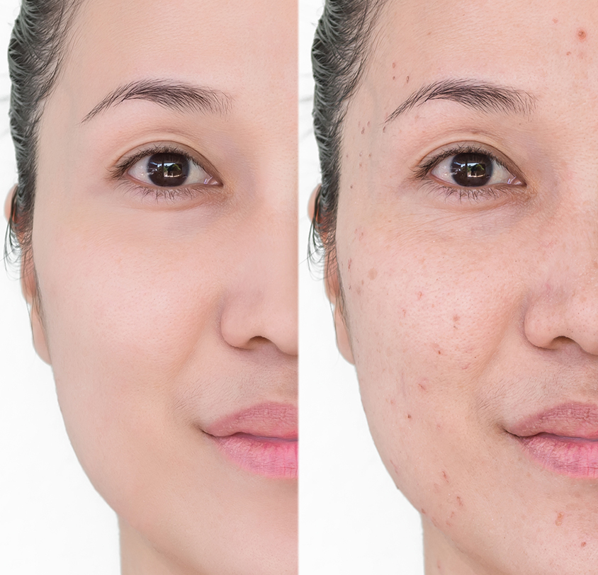 What are Laser Pigmentation Treatments?
